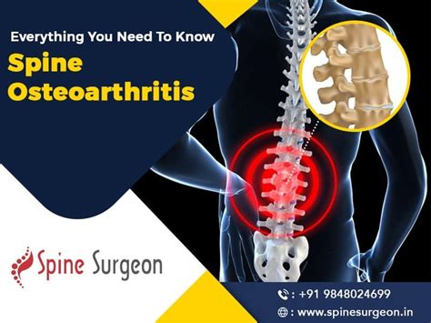 Osteoarthritis Of Lumbar Spine