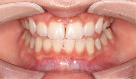 Tongue Thrust And Orthodontic Relapse Dr Shereen Lim