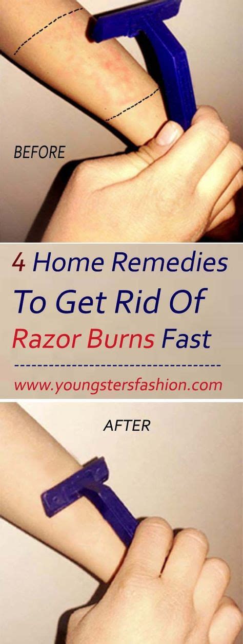 4 Home Remedies To Get Rid Of Razor Burns Fast Razor Burns Burn