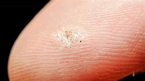 Seed Warts Contagious On Fingers Home Remedies On Foot