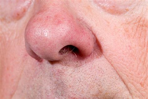 What Are Nasal Polyps And How Do You Treat Them For Better Us News