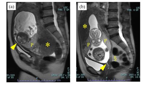 Sagittal T2 Weighted Mr Images Of Case 2 An Enlarged Uterine Fundus