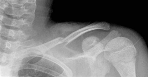 The following are the most common causes of clavicle fracture: Fracture clavicule enfant - Carabiens le Forum