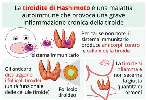 Tiroidite Di Hashimoto Cliccascienze