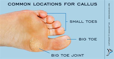 Causes And Symptoms Of Callus Mass4d® Insoles Mass4d® Foot Orthotics