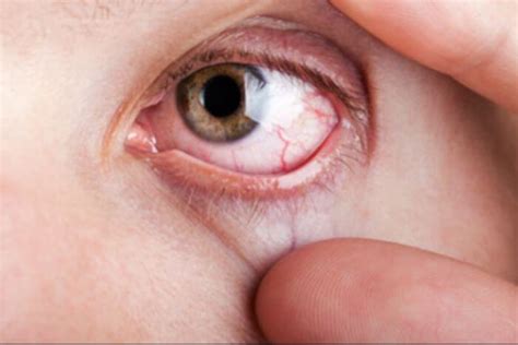 Can Diabetic Eye Disease Occur Even If My Vision Is Normal Providence
