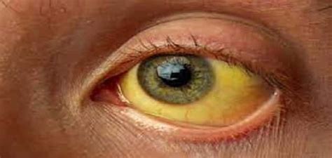 درجات اصفرار العين