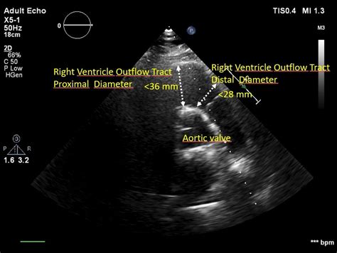 Right Ventricular Outflow View