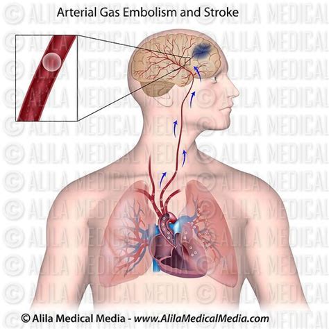 Alila Medical Media Gas Embolism And Brain Stroke Medical Illustration