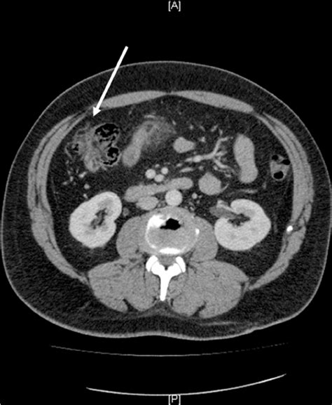 Ct Scan Of The Abdomen And Pelvis Revealed An Abnormal