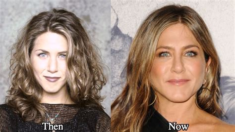 Jennifer Aniston Plastic Surgery Before And After Photos