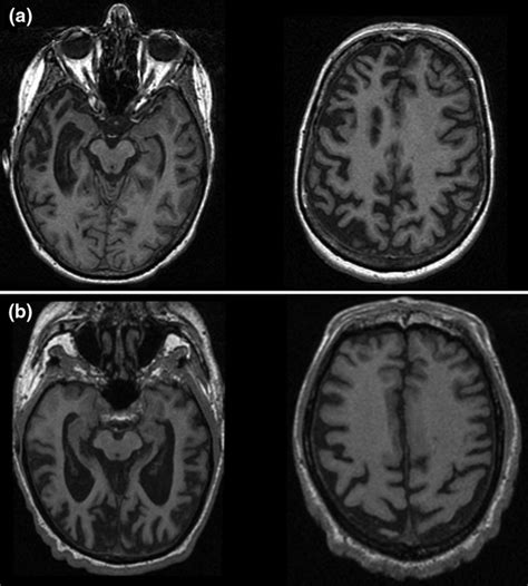 Behavioral Variant of Frontotemporal Dementia - The Brain Clinic