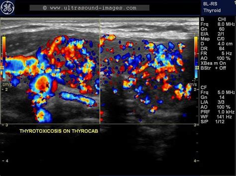 But doctors do have a number of tests they can use to an ultrasound helps your doctor learn more about the thyroid nodule(s). A Gallery of High-Resolution, Ultrasound, Color Doppler ...