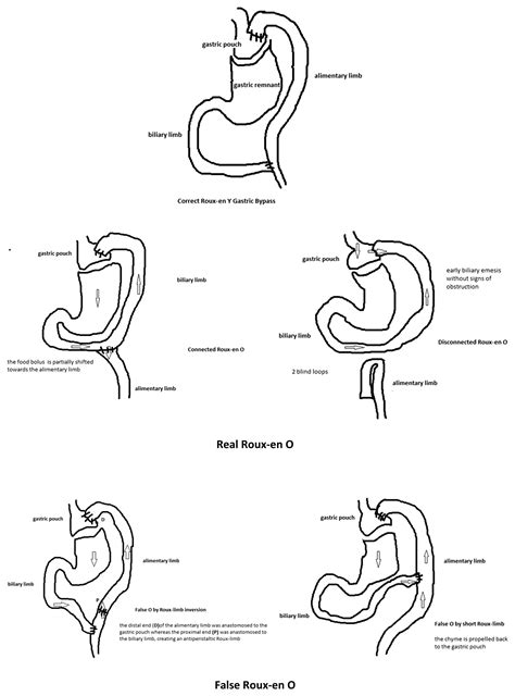 Roux En O Gastric Bypass About One Case Report And