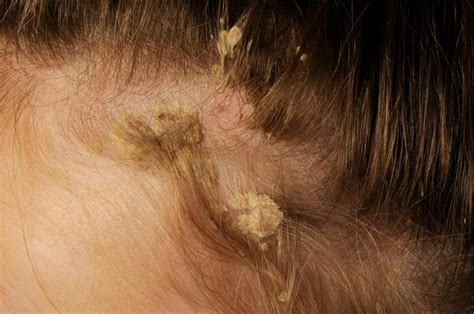 Should You Remove Psoriasis Scales From Scalp 27f Chilean Way