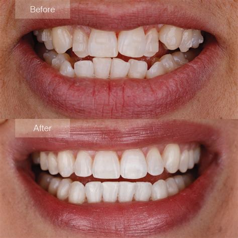 Invisalign Overbite Transformation Before After BeautyKylie
