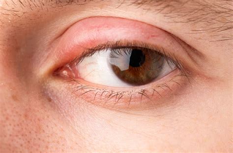 Eye Swelling And Pain Causes And Treatment Thecossackreview
