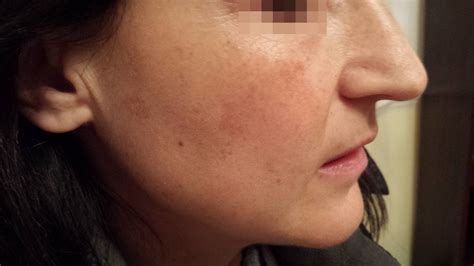 Hormonal Pigmentation Treatment Skin Spots Skin Marks Pigment