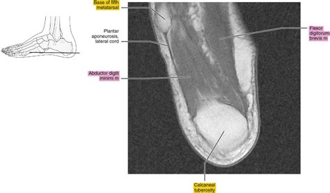 Mri Of The Ankle Radiology Key