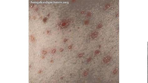 Fungal Infection Rash Youtube