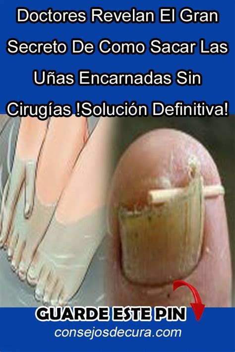 Doctores Revelan El Gran Secreto De Como Sacar Las Uñas Encarnadas Sin