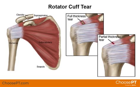 Guide Physical Therapy Guide To Rotator Cuff Tear Choose Pt