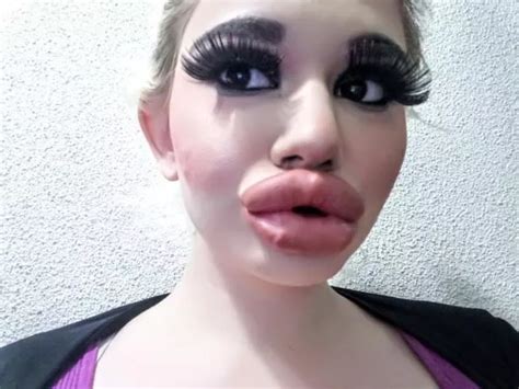 Woman Who Wants Biggest Lips In The World Shares Snaps Of Ever Growing