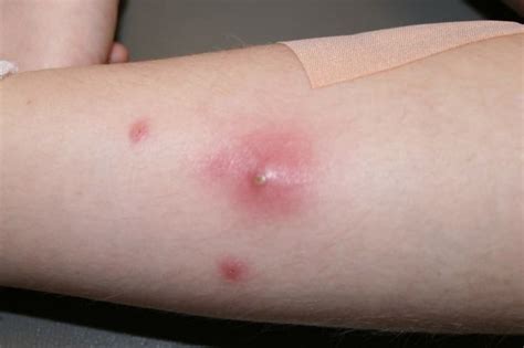 How Long Does It Take For Cephalexin To Work On Skin Infection Skin
