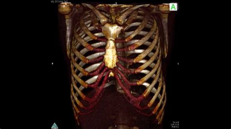 Thorax Anatomy Ct 3d Youtube