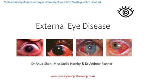 External Eye Disease Primaryophthalmology