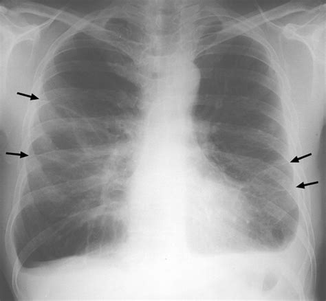 Asbestos When The Dust Settles—an Imaging Review Of Asbestos Related