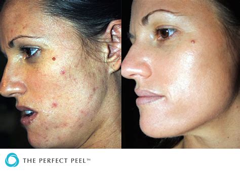 Chemical Skin Peels London Harley St Midlands And Cotswolds