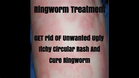 Ringworm Stages The Different Stages Of Ringworm Infection
