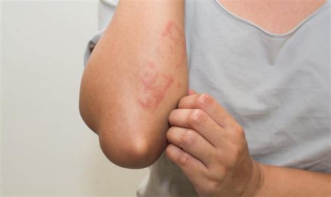 We would like to show you a description here but the site won't allow us. 濕疹如何預防、保養與根治？醫師3關鍵完整解答 - CMoney