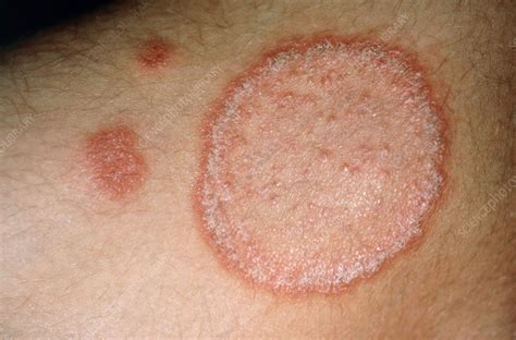 Ringworm Stock Image C0430626 Science Photo Library