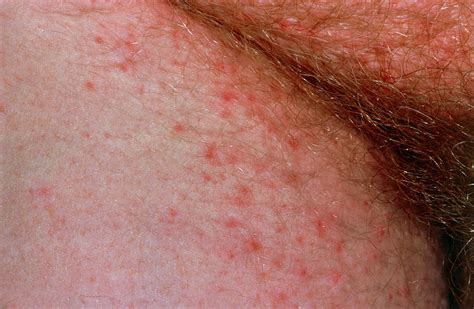 Fungal Skin Rashes In Groin CLOUDYX GIRL PICS
