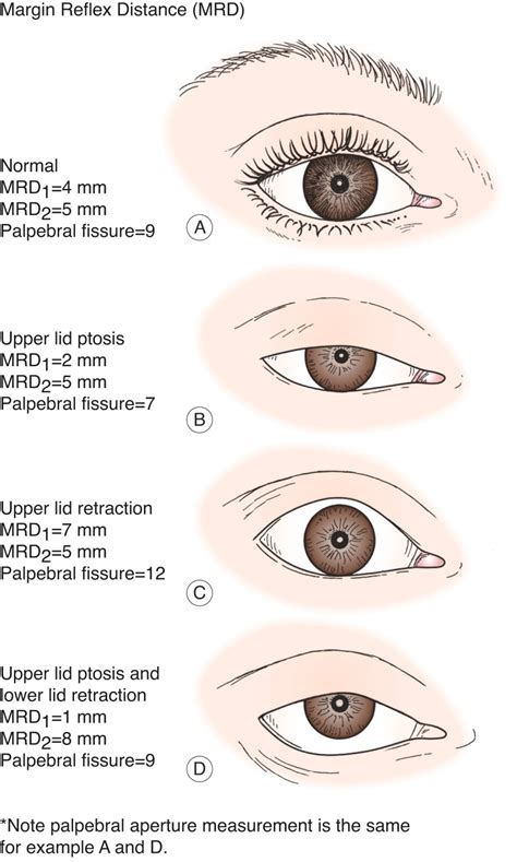 Evaluation And Treatment Of The Patient With Ptosis Ento Key