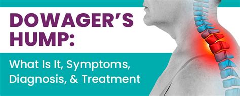 Dowagers Hump What Is It Symptoms Diagnosis And Treatment