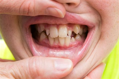 How To Tell When Your Kid Needs Braces