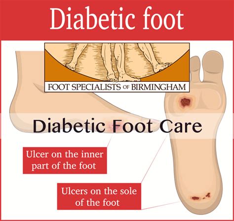 Early Signs And Symptoms Of Diabetic Foot Problems
