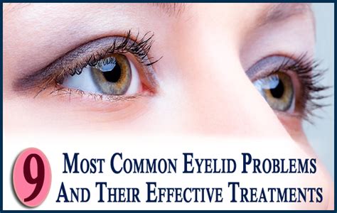 9 Most Common Eyelid Problems And Their Effective Treatments 2023