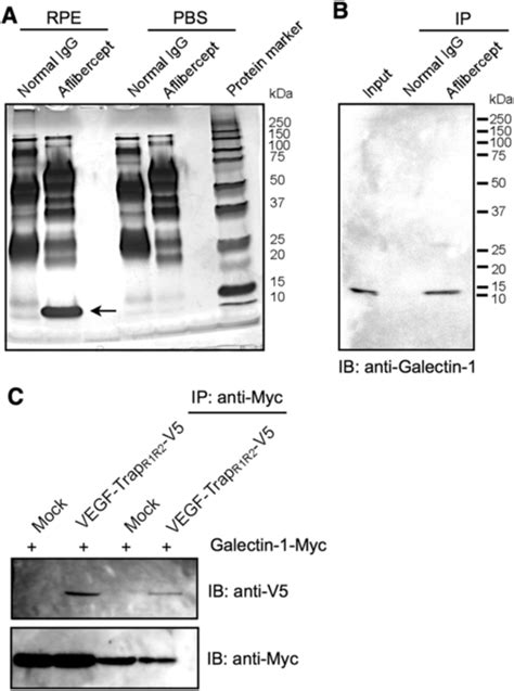 Aflibercept, sold under the brand names eylea and zaltrap, is a medication used to treat wet macular degeneration and metastatic colorectal cancer. Molecular binding of aflibercept with galectin-1.: (A ...