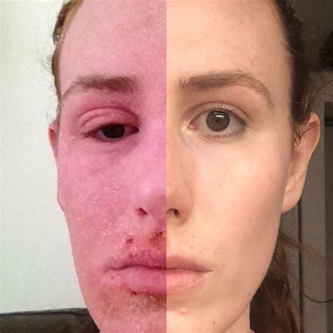 Month 75 Topicalsteroidwithdrawal Eczema Redskinsyndrome Rss