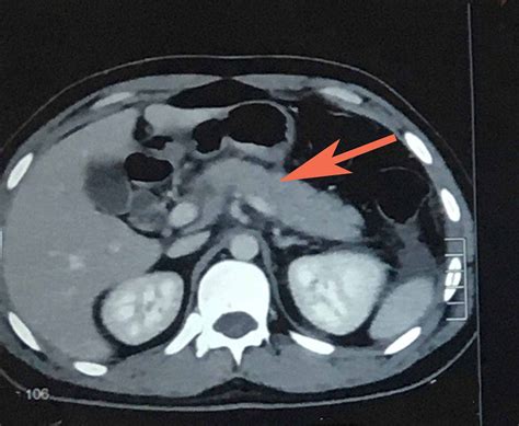 Cureus Ascaris Lumbricoides Infestation As An Unexpected Cause Of