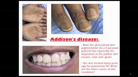 Addison S Disease Adrenaline Dasteb