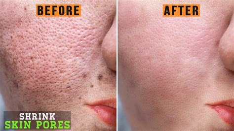 Get Rid Of Pores Scars And Shrink It Quick How To Close Open Pores
