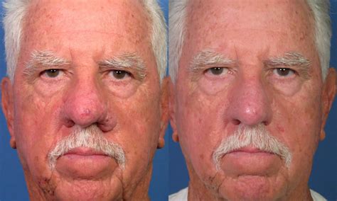 Learn About San Diego Rhinophyma Surgery Treatment With Laser