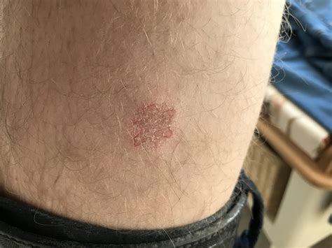 Anyone Tell Me If This Is Psoriasis Had It On Other Leg But It Went