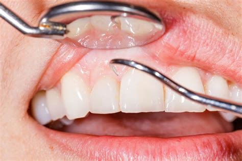 What Happens In A Gum Graft Procedure From A Periodontist Brighton