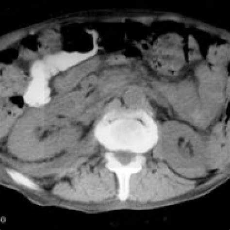 Computerized Tomographic Ct Scan Of The Abdomen Without Contrast